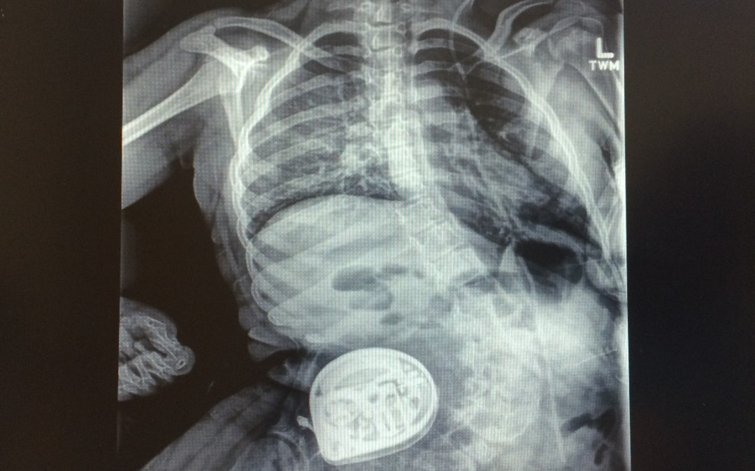 Kennady’s Scoliosis